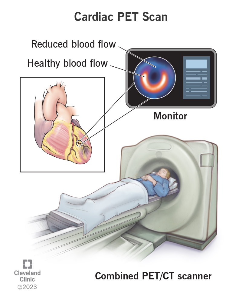 Pet Scan How Does It Work